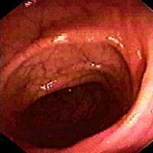 Normal Colonic Microbiota & Mucosa (Abnormal