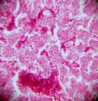 Figure 6: Photo Micrograph of Liver Shows Severe Congestion in Central Vein and Sinusoidal Area with Degenerative Changes of Hepatocytes. H&EX400 4.