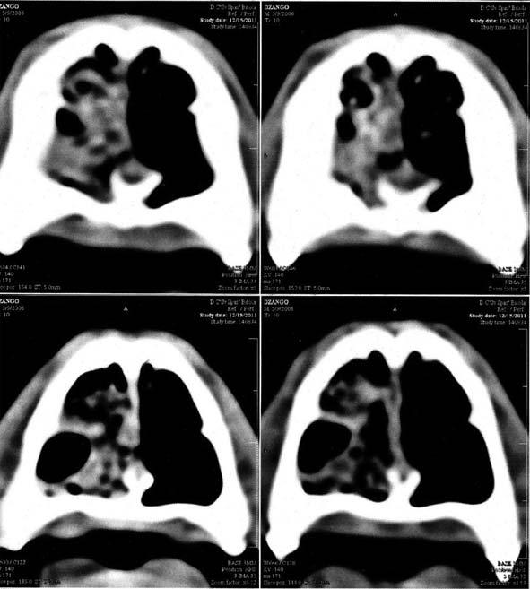 Original Article Magnetic resonance imaging was performed after computed tomography. MRI shown soft-tissue proliferation, 2 cm from the opening of the nasal cavity in caudal direction.