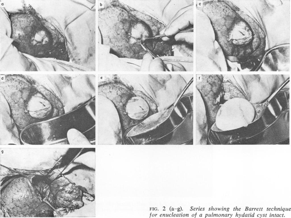 cyst as the patient lies are stretched and torn, exposing an increasing area the lung intact as the slender tissues over the cyst on the table.