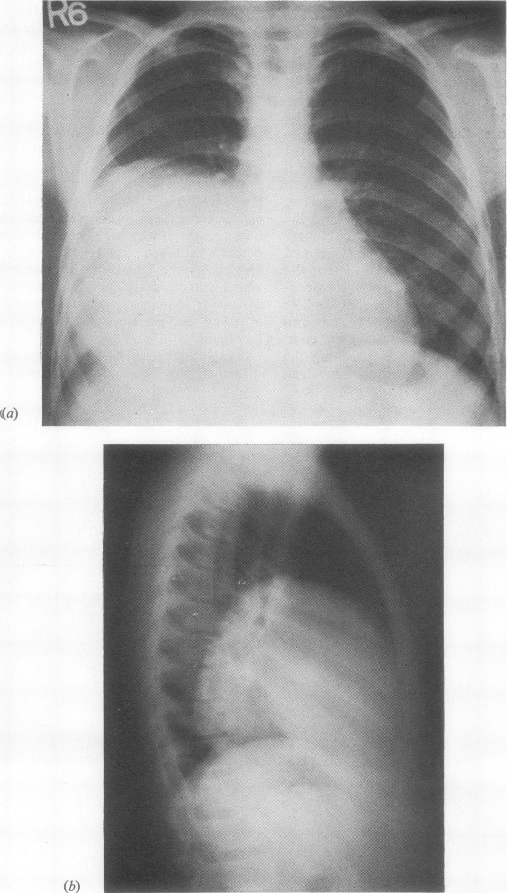 532 (1) Ivan Lichter Thorax: first published as 10.1136/thx.27.5.529 on 1 September 1972. Downloaded from http://thorax.bmj.com/ 1h)) FIG. 3. Case 1.