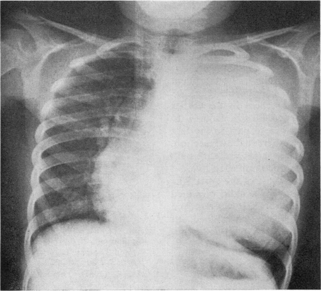 Surgery of pulmonary hydatid cyst-the Barrett technique the walls of the space. These are closed to prevent the development of tension pneumothorax and possibly an empyema.