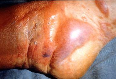 gangrenous wound it could spread