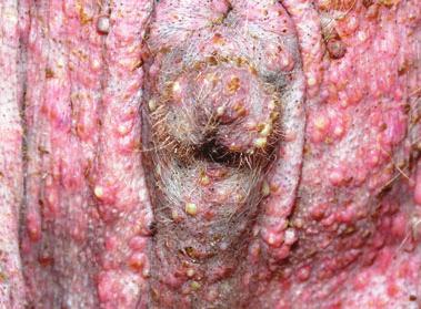 Scenario 2a: the alopecic areas are scaly and erythematous with a few comedones. Scenario 2b: papules, pustules, crusts and copious exudation are prominent in the alopecic areas.