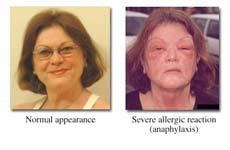 g. Bee sting allergies 4) Causes of disease 5) Disease vectors Psychological