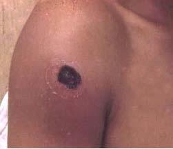Cutaneous Anthrax Spore enters skin Incubation of 2-3 days Papule develops Black eschar forms Anthrax = coal