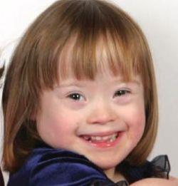 Down Syndrome Down syndrome: Trisomy 21 if chromosomes fail to