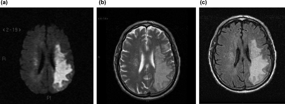 Meningoencefalitis in MSF Case reports: meningitis-encephalitis-myelitis Aliaga L et al.