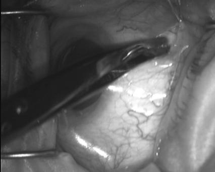 Given after the prep Small incision made inferior nasal Dissection with blunt scissors past equator of globe Injection given with blunt cannula inferior nasal