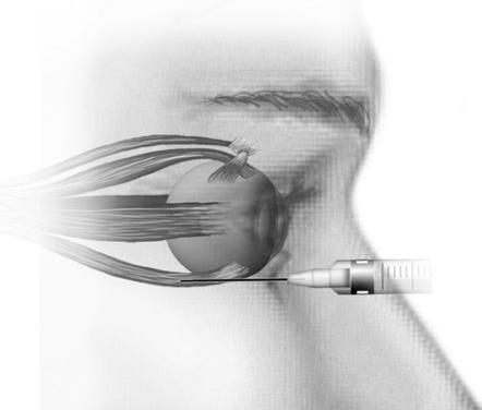 Given outside of muscle cone Needle starts in same place; inferior lateral orbital rim Directed under and away from globe Larger volume used; diffuses into retro space Safety Not likely to hit optic