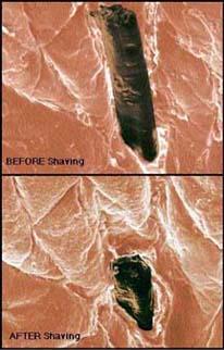 Pathophysiology of Shaving & SSI Hair removal with a razor can disrupt skin integrity Microscopic exudative rashes and