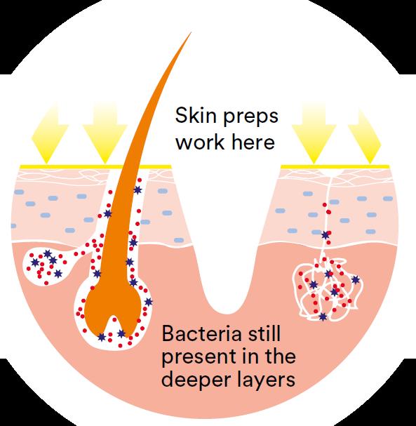 Preps Alone Can t Eliminate Bacteria on a Patient s Skin Use a skin prep to reduce as much bacteria on the skin as possible However, antiseptics work primarily on the skin surface, NOT in the deeper