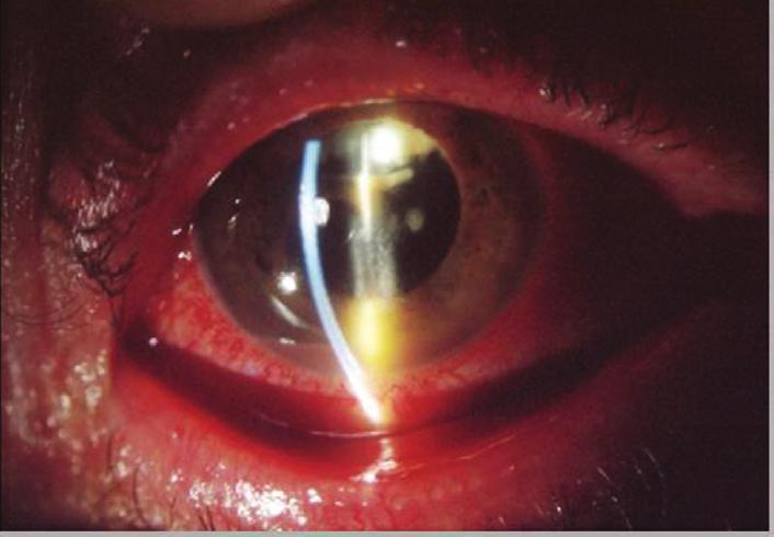 The majority of patients with acute postoperative endophthalmitis present within 1-2 weeks after surgery, with signs and symptoms of rapidly progressive intraocular inflammation.