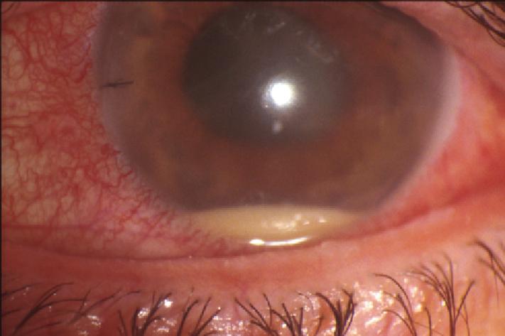Two recent large series of acute endophthalmitis cases after cataract surgery describe substantially different mean times to presentation - 5 days [Pijl 2010] vs 13 days [Lalwani 2008] - with the