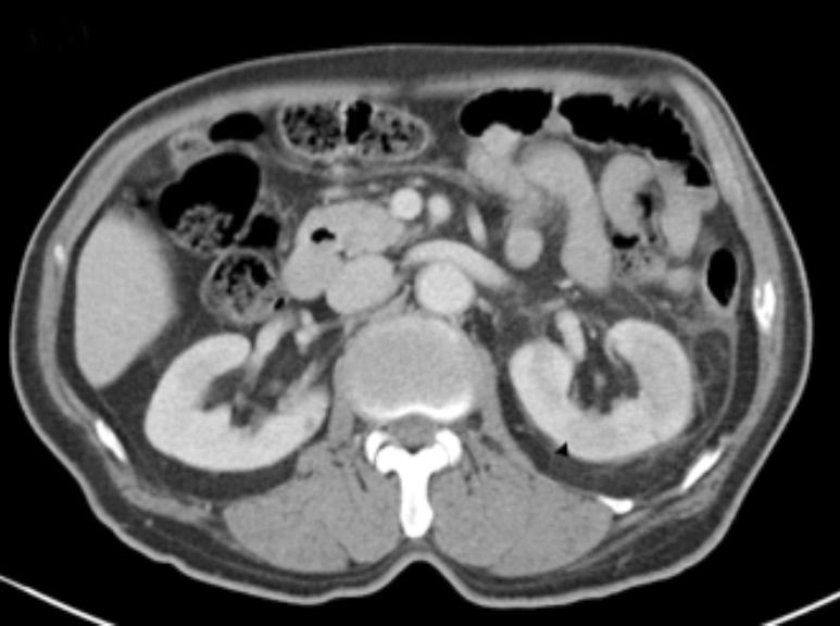 50 Ga Hee Lee, et al. Acute Pyelonephritis with E. hirae Fig. 1. Computed tomography scans of the first patient.