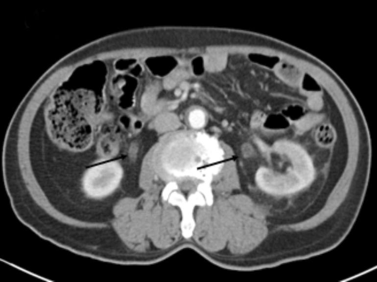 (B) Delayed phase; multifocal wedge shaped poor enhancing lesion in the left kidney (dotted line arrow). Fig. 2. Antibiogram of the first patient.