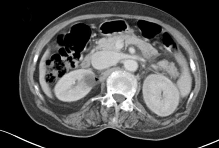 Ga Hee Lee, et al. Acute Pyelonephritis with E. hirae 51 Fig. 3. Computed tomography scans of the second patient.