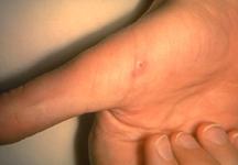 Cat Scratch Disease Most common in children 2