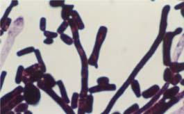 Microscopically the fungal mycelia were septate and some were fragmented into rectangular arthrospores (arthroconidia) in both