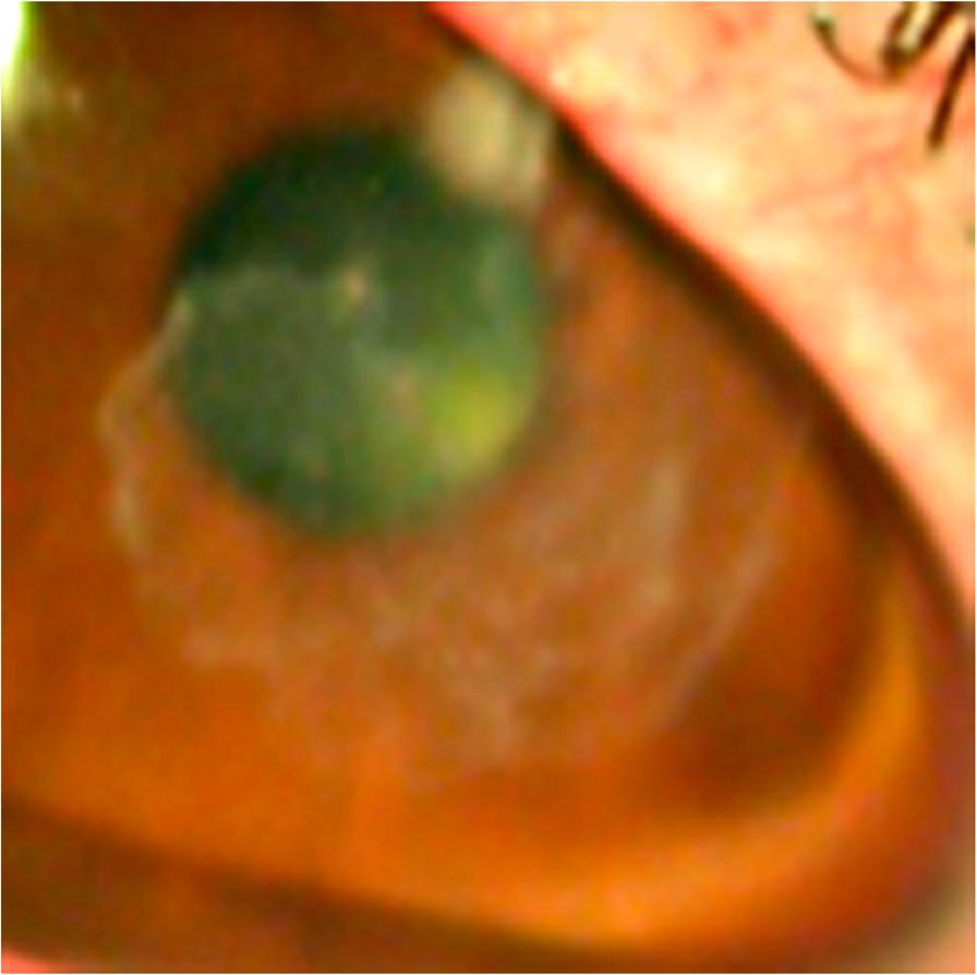 Sharma and O Hagan Journal of Ophthalmic Inflammation and Infection (2016) 6:23 and epithelial defect resolved leaving a dense central corneal scar over the subsequent 3 weeks.