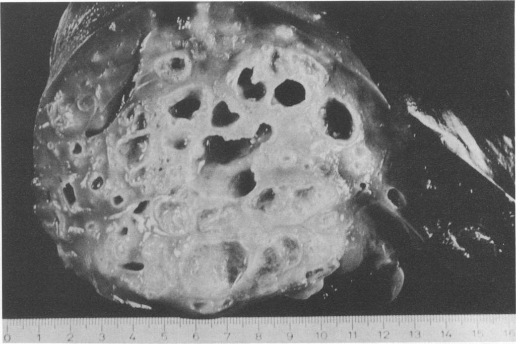 VOL. 5, 1992 DIAGNOSIS OF ECHINOCOCCOSIS 253 FIG. 4. E. multilocularis. Cross section through a human liver with alveolar echinococcosis.