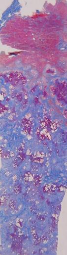 Echinococcus multilocularis Fragment of the liver capsule -connective tissue Liver tissue Around parasite s follicles granulomas, there are Resorption granulomas,