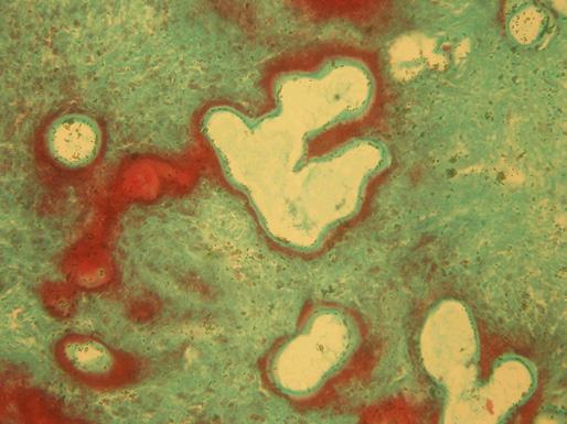 Multiple follicles of Echinococcus multilocularis green laminar layer. No other parasite tissues inside.