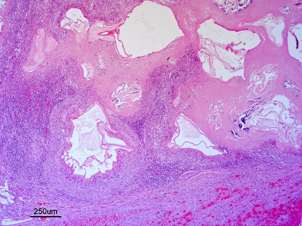 Histology multi-loculated cystic