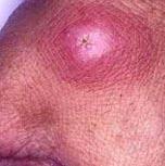boil, an insect bite, a spider bite, or a sore or lesion