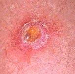 Staph bacteria, including MRSA, can cause skin infections
