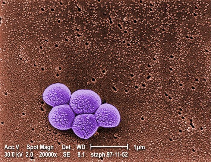 Methicillin-Resistant Staphylococcus Aureus (MRSA) First isolated in US in 1968 1% of population is colonized with MRSA