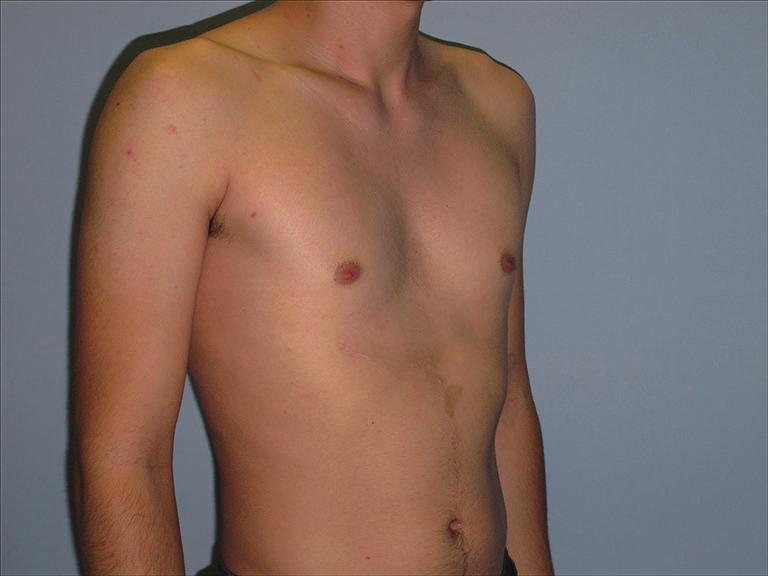 Figure 3 Moderate PE deformity in a 22-year-old patient without functional