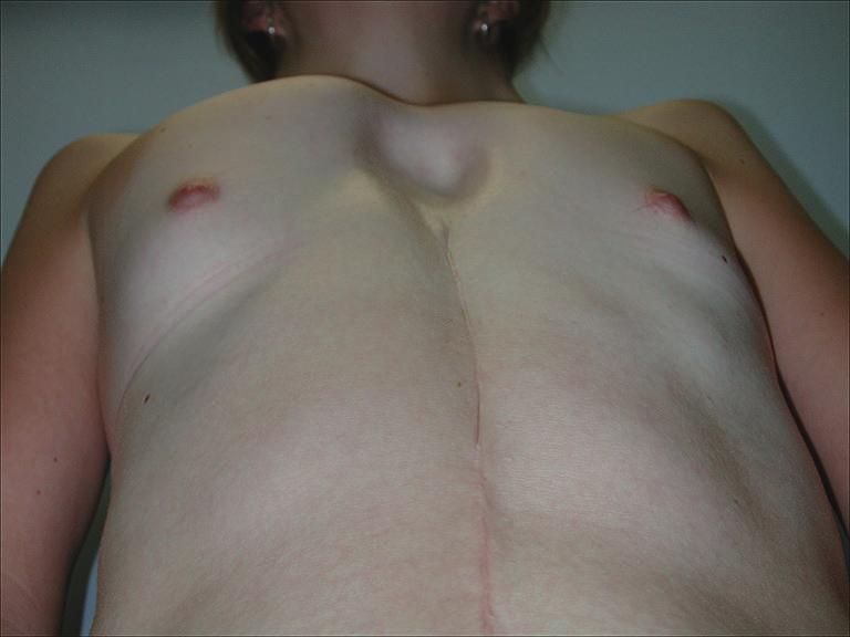 () Preoperative situation; () situation one year thereafter with excellent result