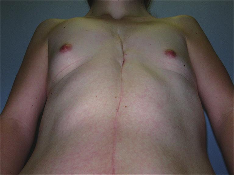 Figure 4 20-year-old female with Noonan syndrome and pectus arcuatum deformity.