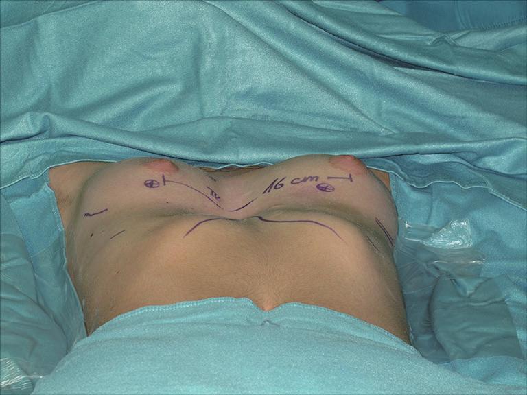 distortion of breasts conjoined with PE deformity.