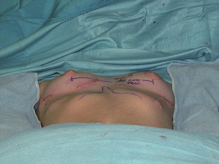 breast strabism; (C,D) intraoperative situs after hybridized