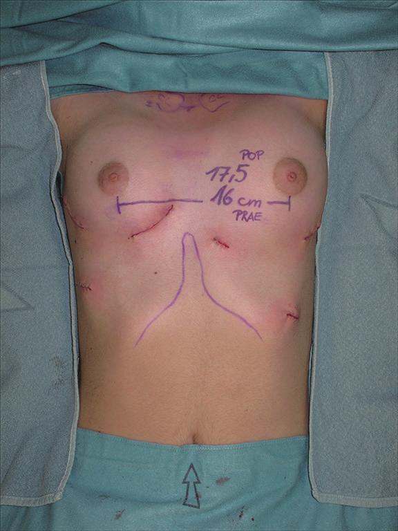 5 cm in intermamillary distance; strabism and asymmetry