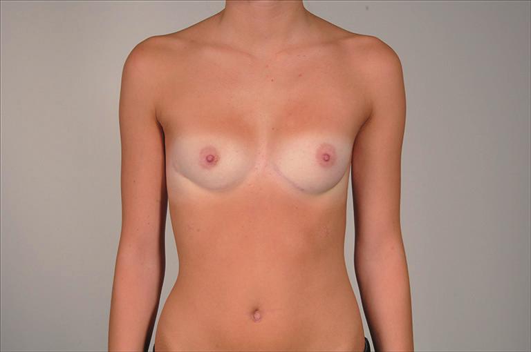 Situation six months after pectus bar removal and simultaneous correction with a 150 cc breast implant on the right side (C). PE, pectus excavatum.