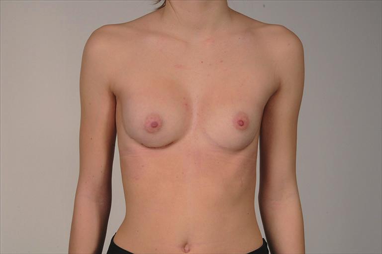 Final result after pectus bar removal and breast augmentation with 270 cc implant on the right and 160 cc implant on the left side. PE, pectus excavatum.