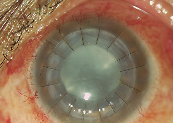374 Fig. 2. Mild corneal graft edema, no anterior chamber reaction and lens opacity. References 1 Chen KJ, Lai CC, Sun MH, et al: Postcataract endophthalmitis caused by Enterococcus faecalis.