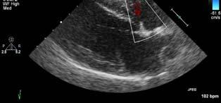 Duke Diagnosis Heartworm Disease Microfilaremic Pulmonary Hypertension Tricuspid Regurgitation Pulmonary Infiltrate with eosinophils Right heart failure Pre-renal azotemia (normalized with diuretic