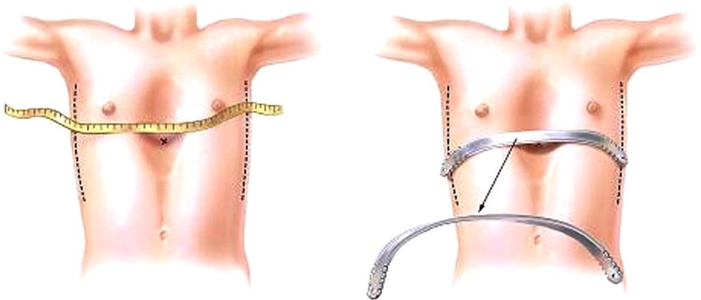 Pectus Excavatum The Nuss Procedure Through two small incisions on either side of the