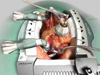 Minimally Invasive Cardiac Surgery Off-Pump CABG Mitral Valve