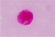 What Types of Cells are Counted? Eosinophil Lymphocytes Polymorphonuclear (PMN) Fragments are counted only if more than 50% of the nuclear material is visible.