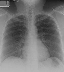 6 FLORENCE ELLIS CASE STUDY The chest x-ray shows no active disease.