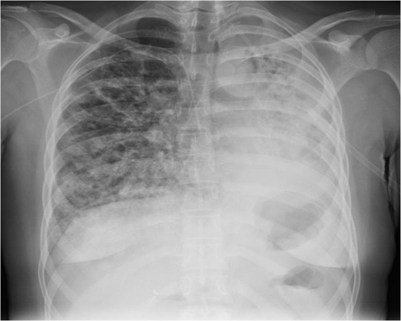 38 year old woman admitted in respiratory