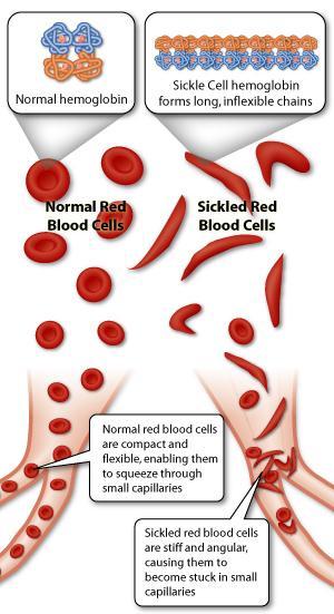 Sickle Cell Anemia-Recessive This disease affects a person s red blood cells A mutation causes the cells to be long and bent ( sickle shaped) The odd shape causes the cells