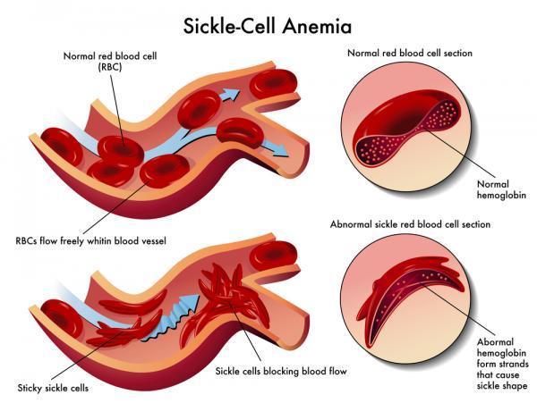Case Study: Sickle Cell Anemia Although we discussed Sickle-Cell Anemia s recessive inheritance pattern,