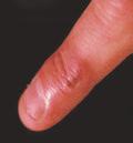rot Wool slip Skin tumours Sunburn Beware: orf, staphylococcal dermatitis,