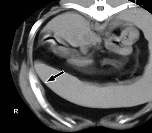 2), showing a heterogeneously enhancing mass in the left cerebellopontine region (arrow).